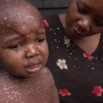 MPOX : les enfants sont les plus touchés par l&rsquo;épidémie
